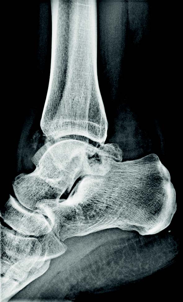 Le syndrome du carrefour postérieur de la cheville