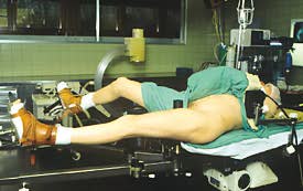 Les clous Gamma (Standard, Trochanteric et Long) : Trucs et astuces de la technique opératoire