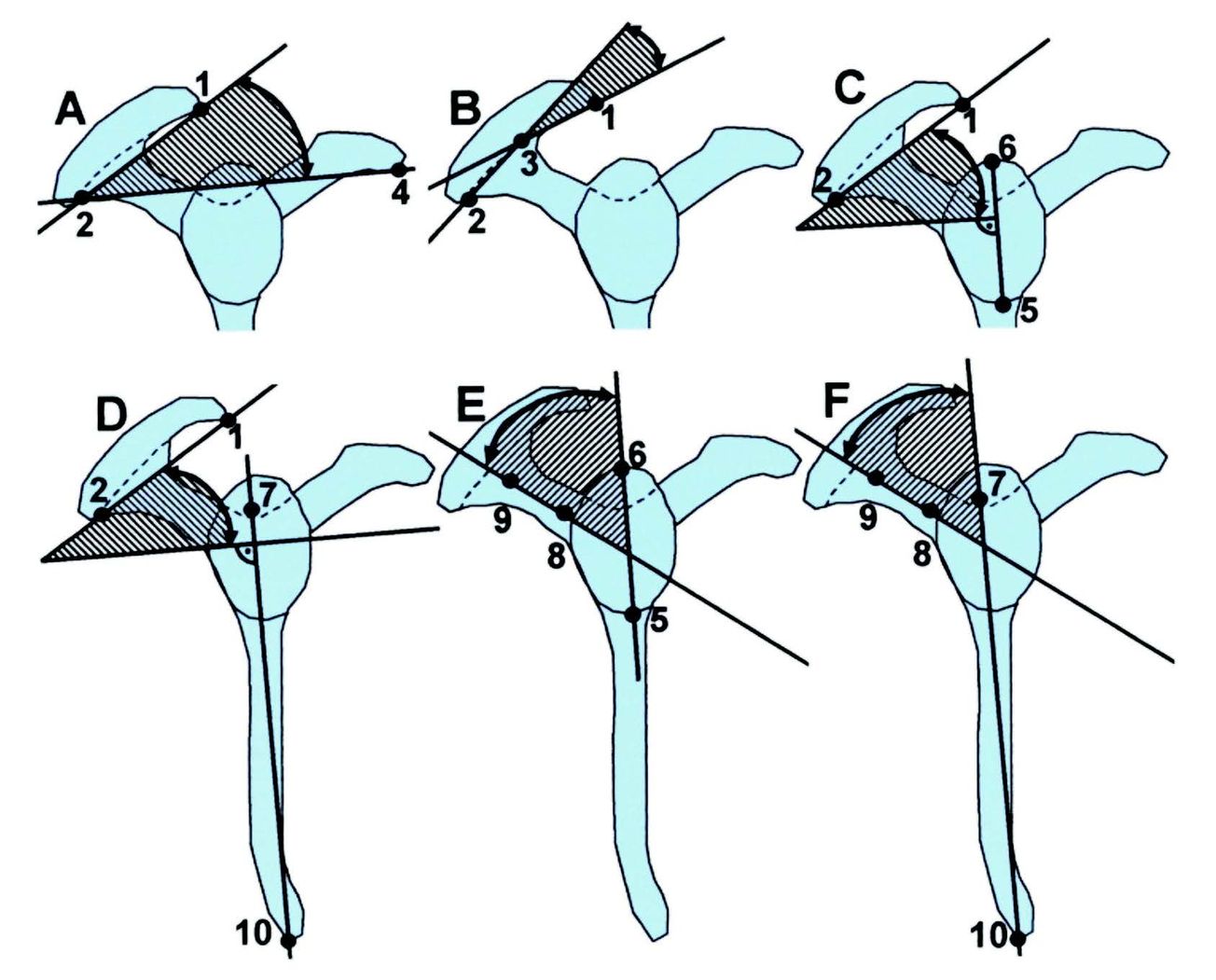 L’acromioplastie : Pourquoi ?