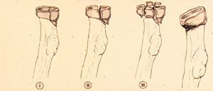 Prothèse de tête radiale. Indication et technique opératoire.