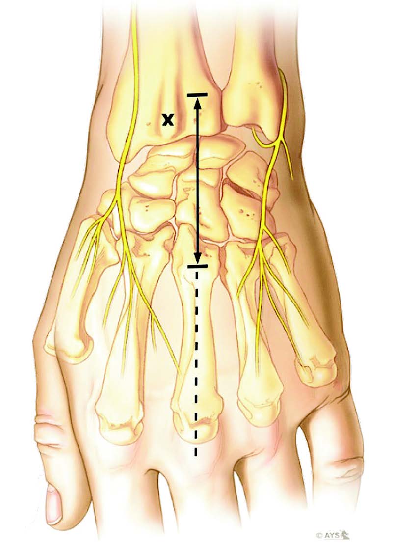 L’arthrodèse des quatre os du poignet par plaque Xpode