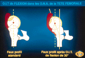 Technique et indication de l'ostéotomie intertrochantérienne de flexion dans les osteonécroses aseptiques de la hanche