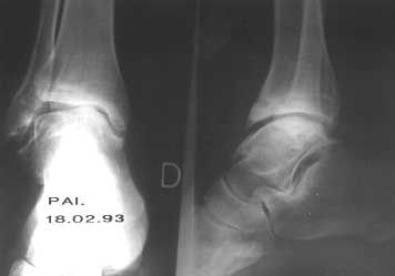 Instabilité chronique de la cheville et arthrose