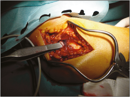 La prise en charge chirurgicale des terribles triades du coude