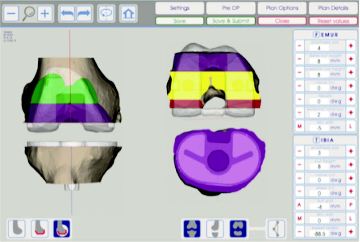 Aspects économiques de l’utilisation de l’ancillaire sur-mesure en chirurgie prothétique du genou