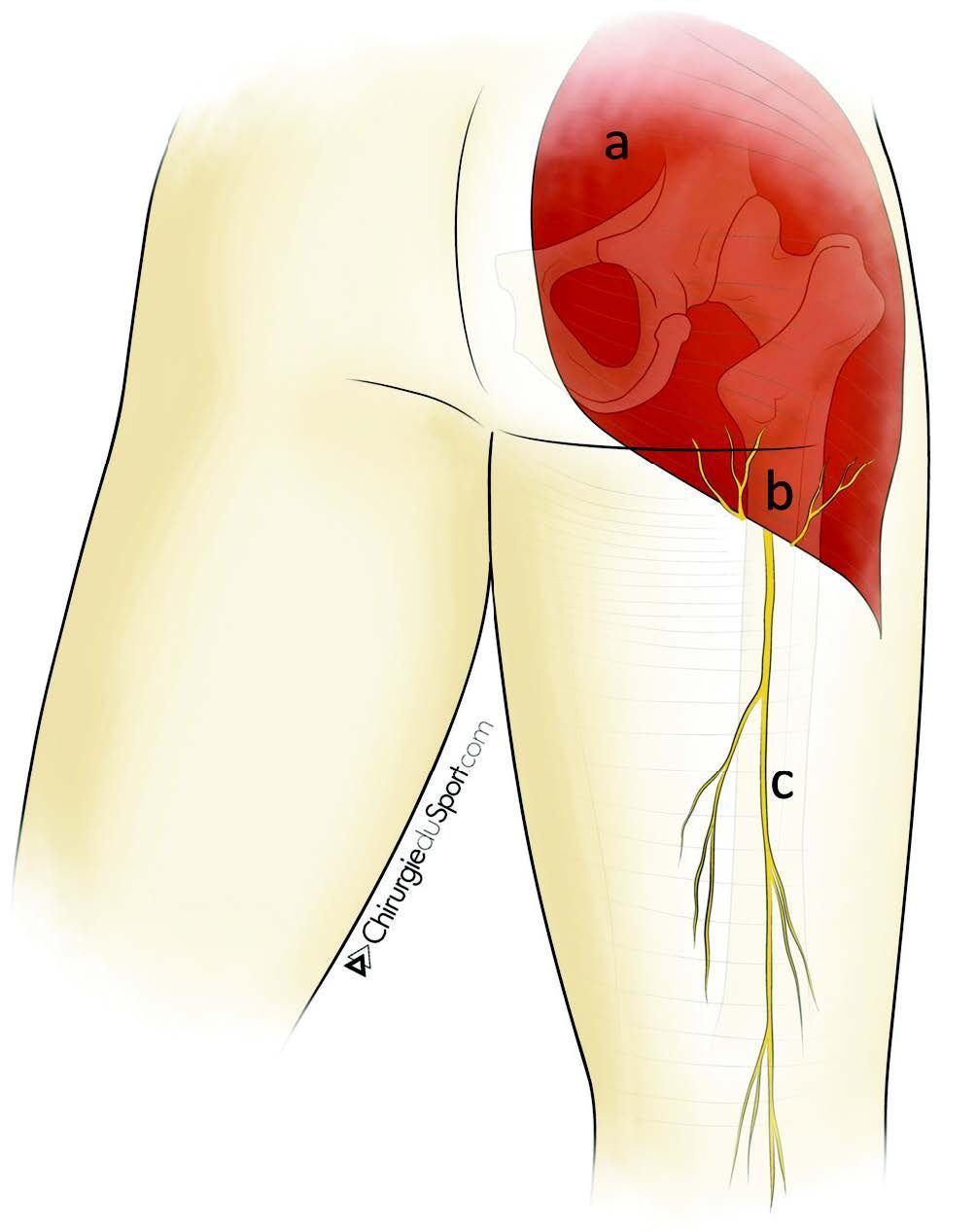Réparation chirurgicale des ruptures aigues proximales des tendons ischio-jambiers