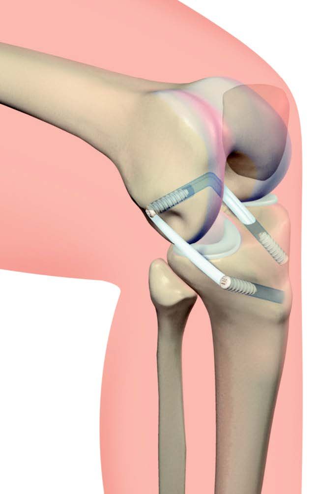 Plastie latérale extra-articulaire additionnelle du genou - Une technique mini invasive originale