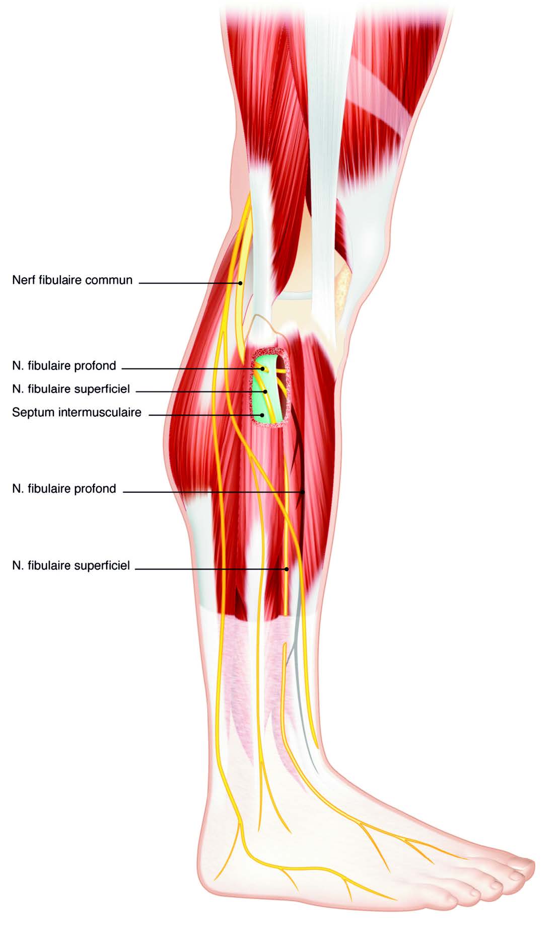 Pathologie du nerf sciatique poplité externe