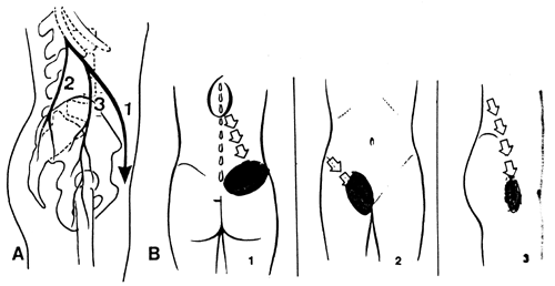 Le syndrome de la charnière dorso-lombaire. Une source d'erreur de diagnostic