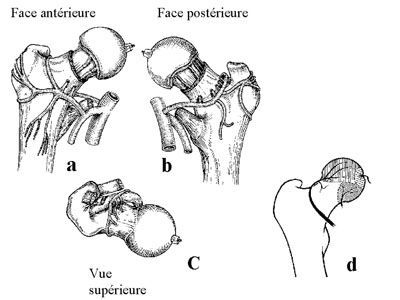 Les fractures de l'extrémité proximale du fémur