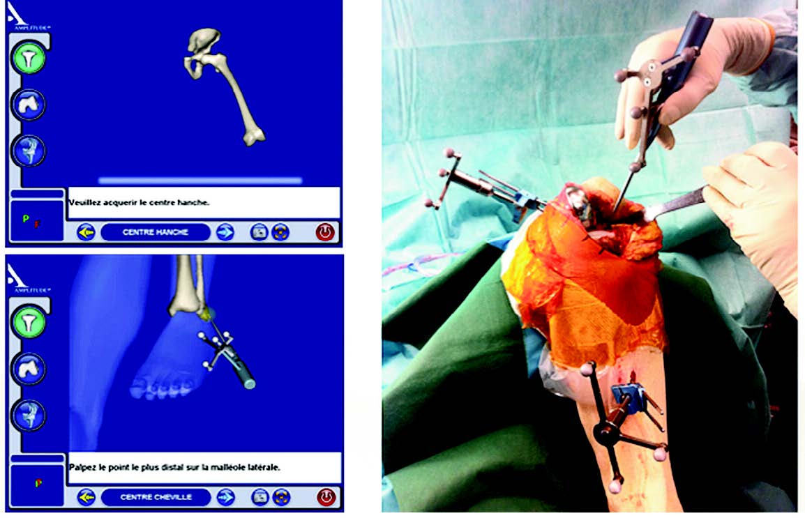 Reprise de prothèse unicompartimentale par prothèse totale de genou. Technique assistée par ordinateur.