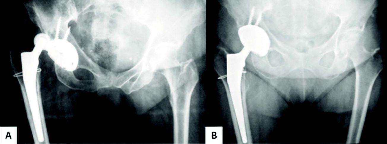 Technique : scellement d’un implant à double mobilité dans une cupule non descellée au cours des reprises de prothèse totale de hanche