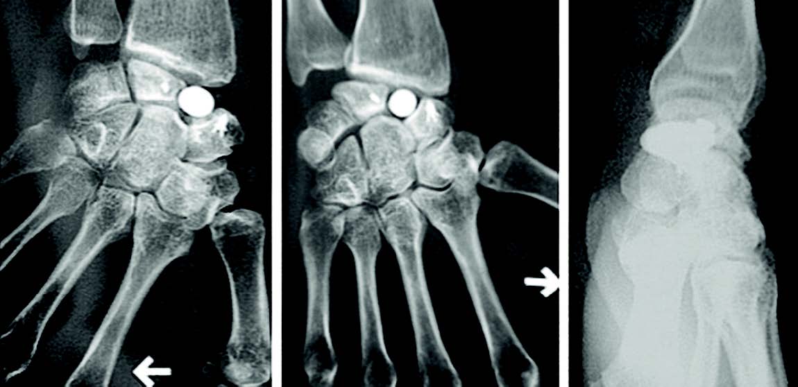 Point actuel sur les prothèses totales du poignet