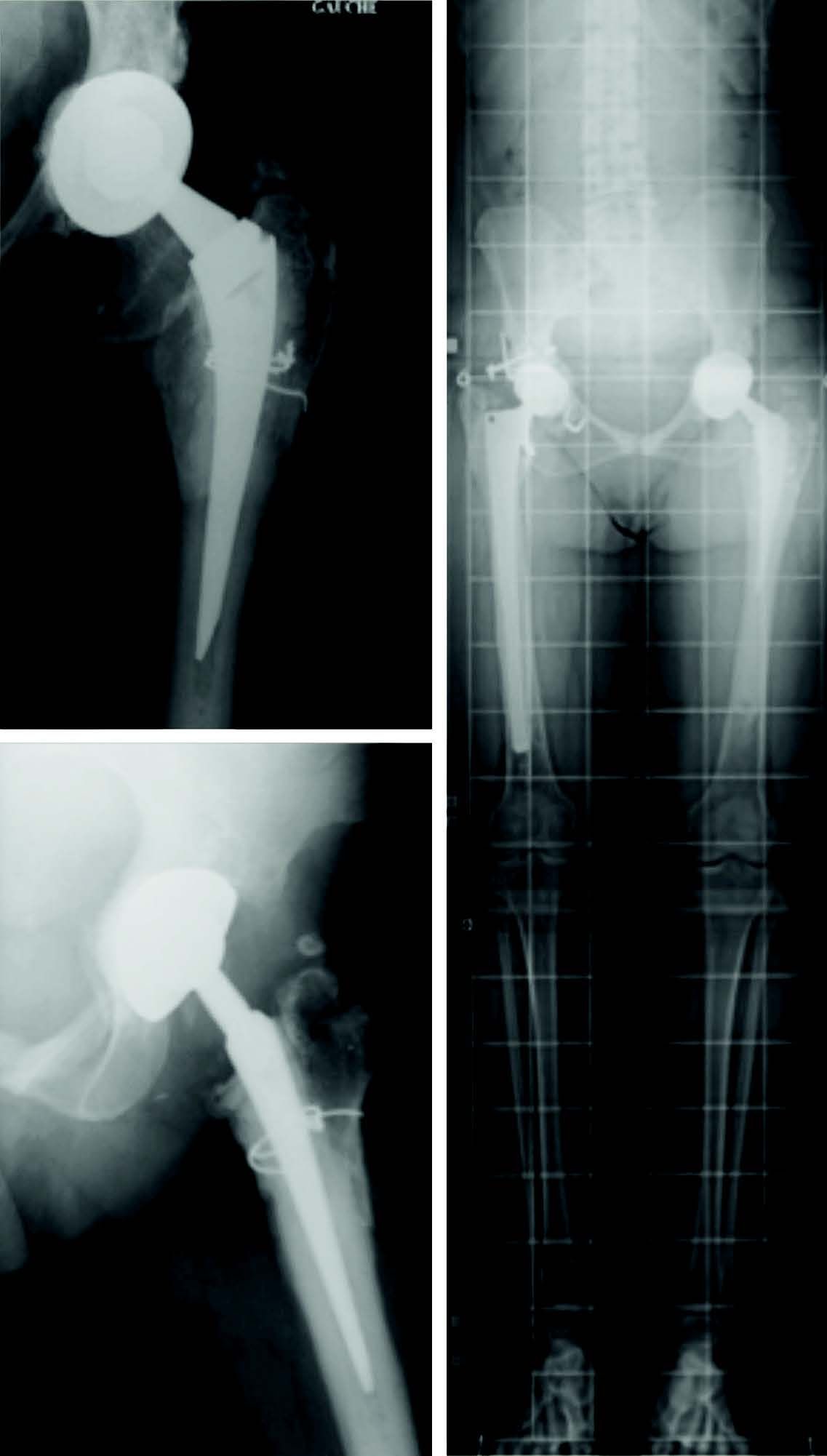 Utilisation du col modulaire dans les prothèses de hanche primaires et de révision