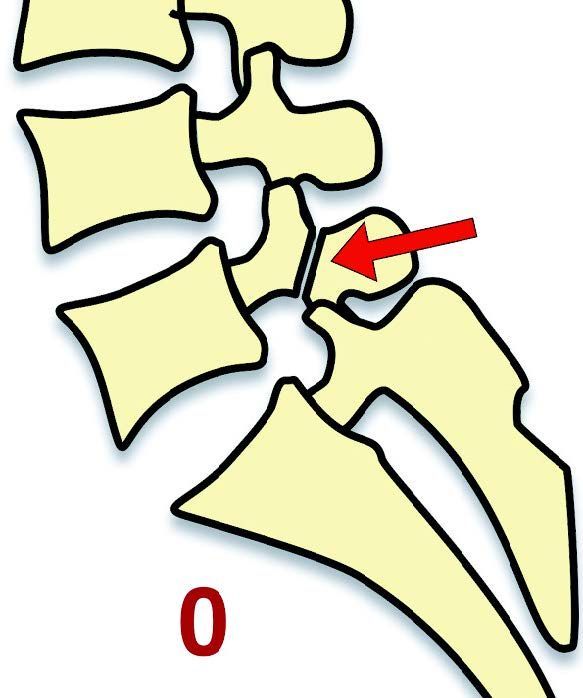 Spondylolyse & Spondylolisthésis isthmique chez l’adulte