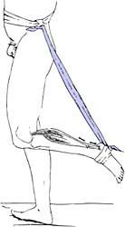 La ténorraphie percutanée du tendon d'achille