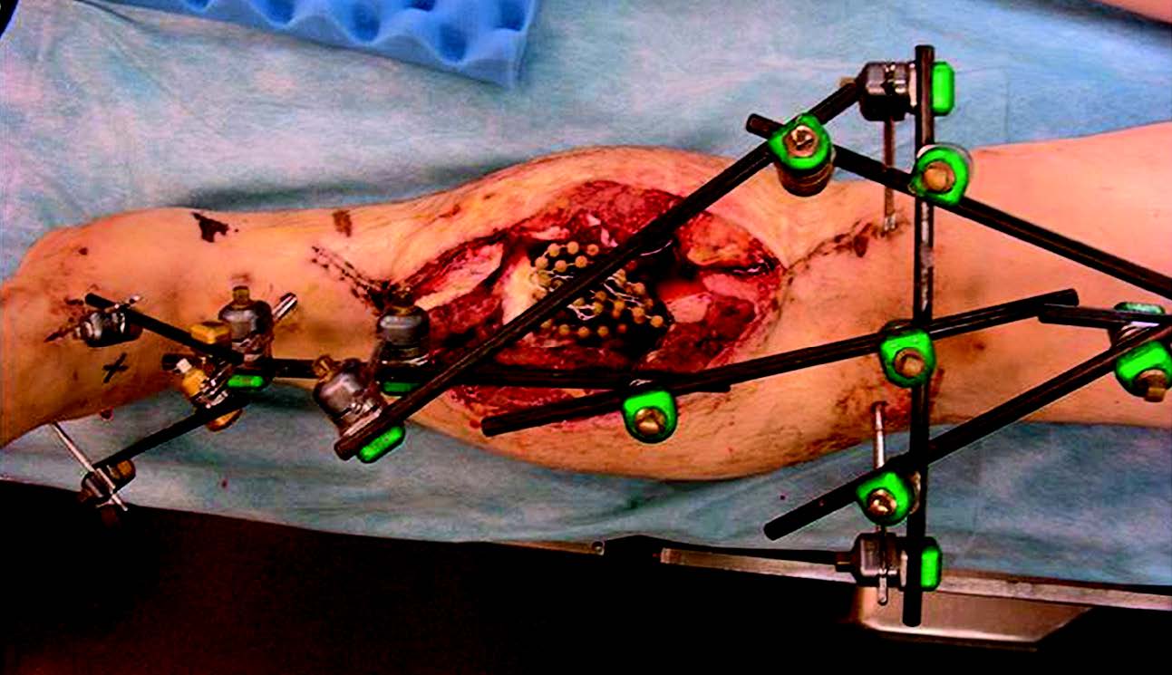 Fractures ouvertes de l’adulte : proposition de prise en charge basée sur une analyse des concepts actuels de « l’evidence-based médecine »