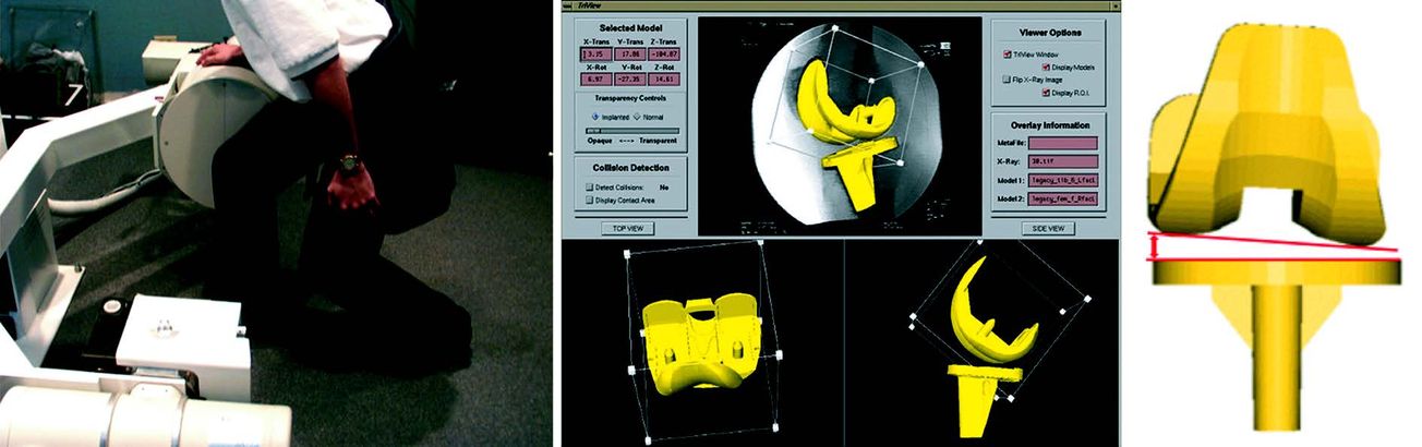 Equilibrage ligamentaire et guides de coupes personnalisés