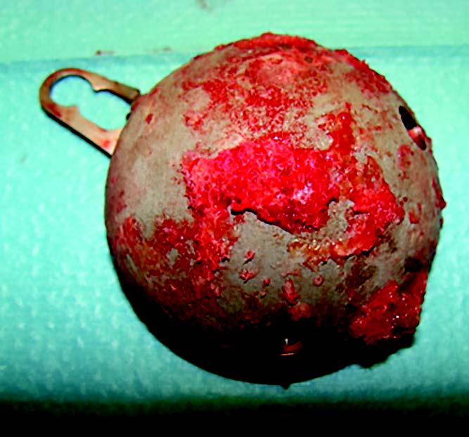 Pourquoi je remets des cotyles à double mobilité dans les reprises de prothèses totales de hanche (PTH)