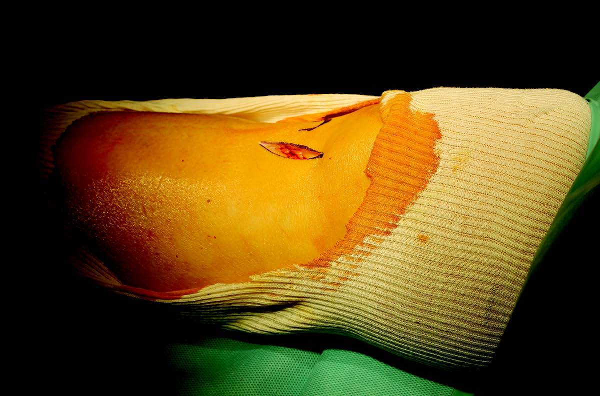 Comment, pourquoi et à qui je fais une ostéotomie du tibia ?