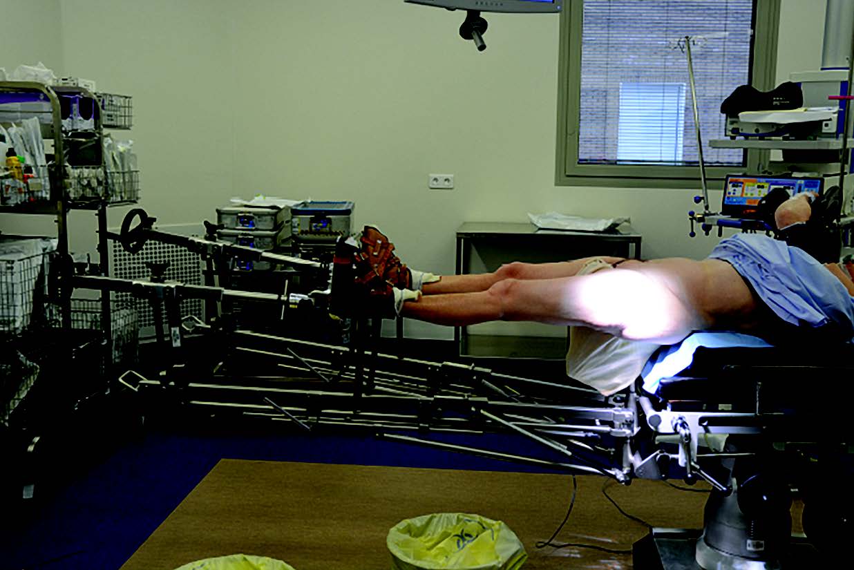 La voie antérieure de hanche dite Hueter-gaine « comme je la pratique »