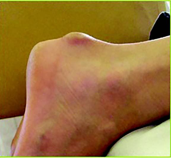 L’intérêt de l’ostéotomie de Zadek  dans les talalgies postérieures