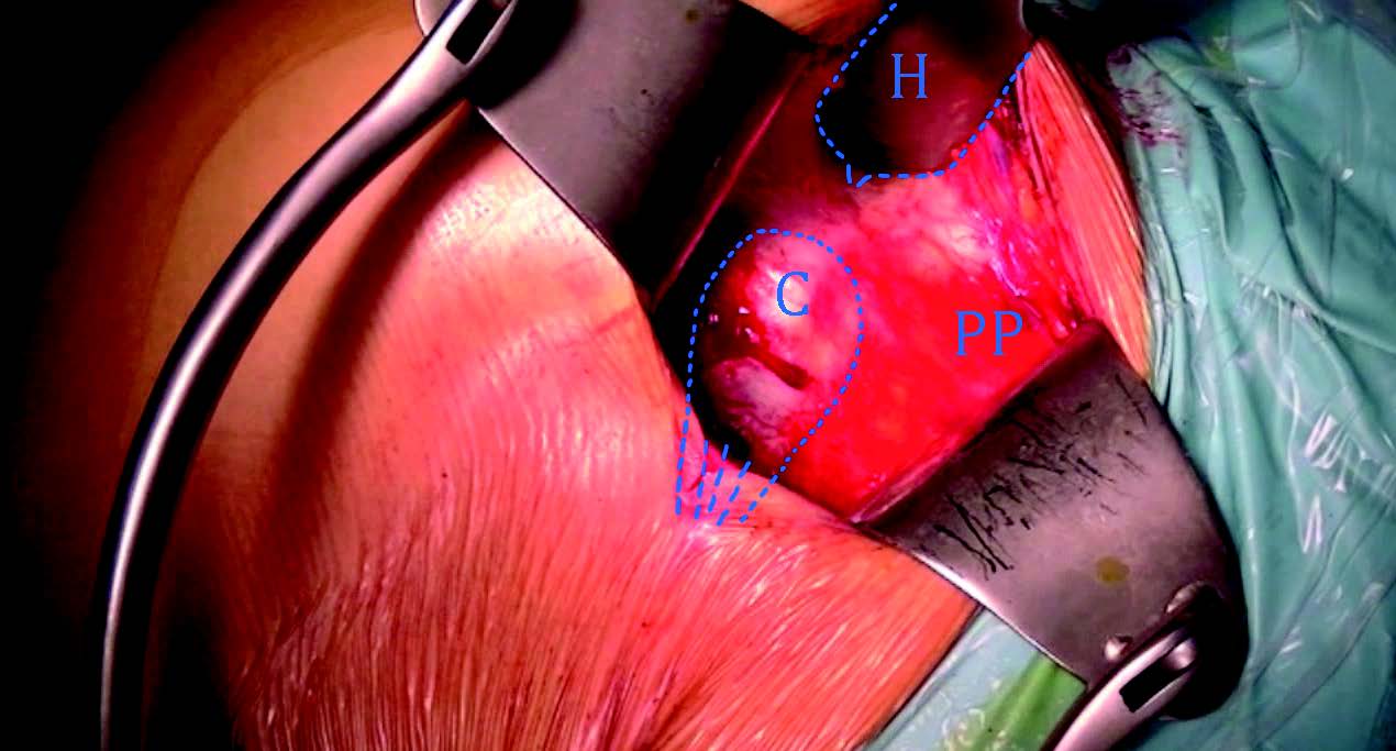 Technique de stabilisation gléno humérale par Butée-Bankart