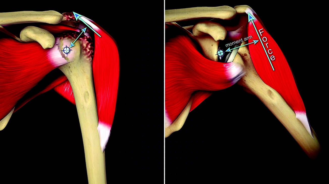 Quoi de neuf en biomécanique des prothèses d’épaule inversées ?