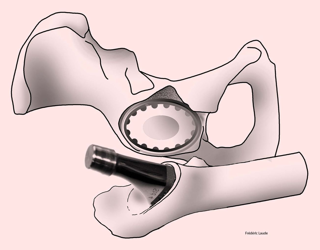Les révisions de prothèse totale de hanche par voie antérieure - Intérêt, indications et limites