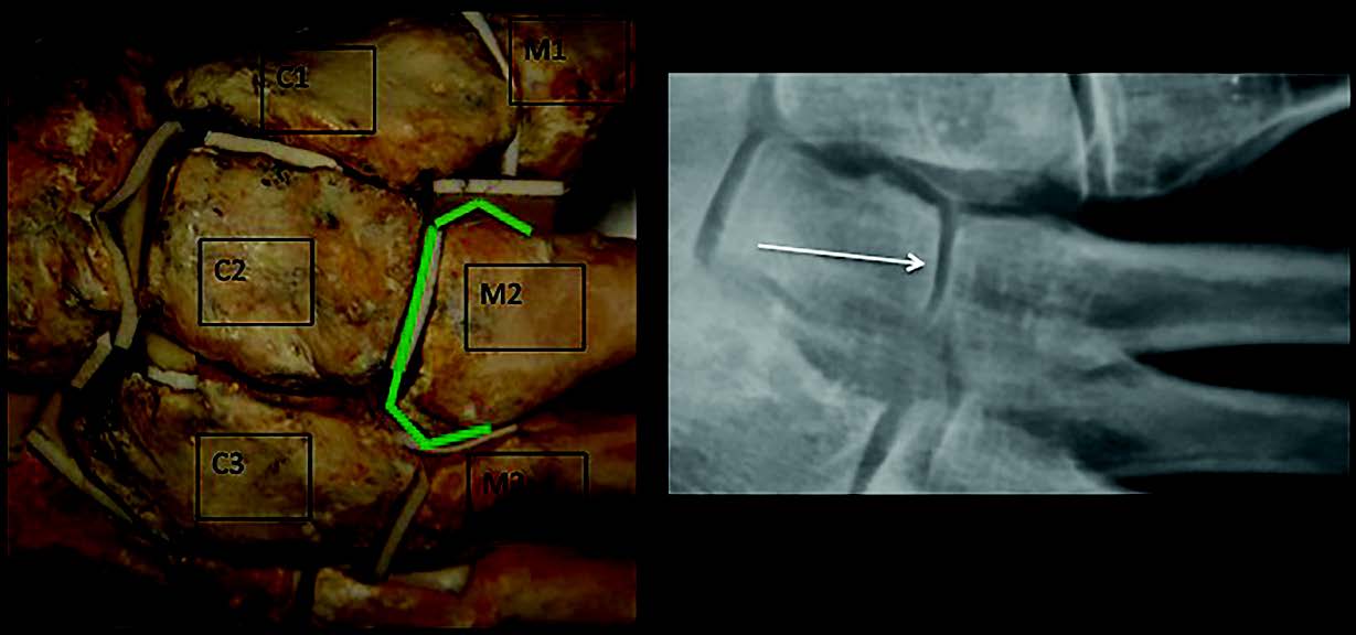 Le syndrome du deuxième rayon