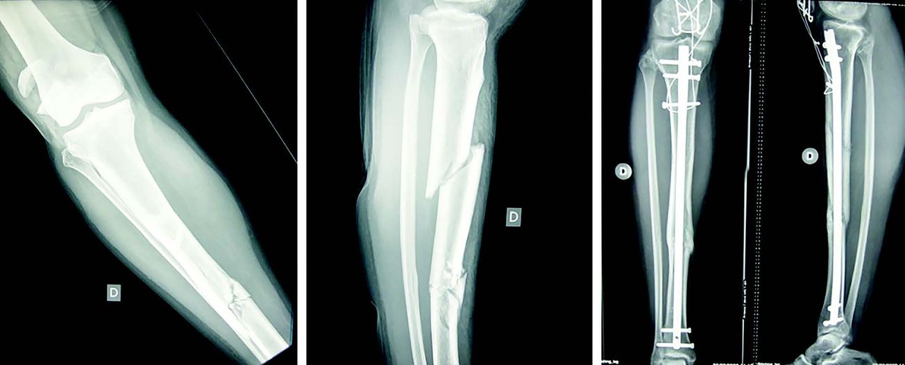 Enclouage centromédullaire alésé des os longs du membre inférieur de l’adulte - Principes techniques et données récentes de la littérature