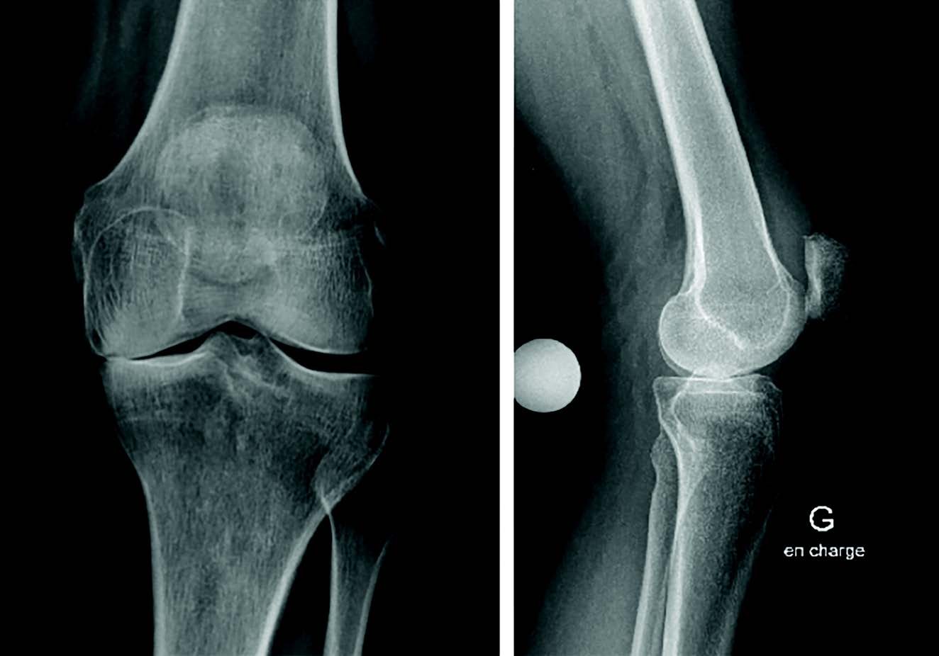 Navio PFS. Instrumentation robotisée sans imagerie préopératoire pour la mise en place des prothèses unicompartimentales