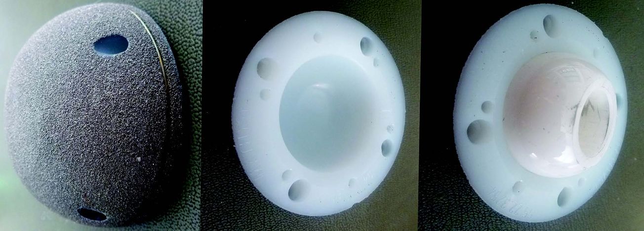 Les raisons d’un choix : une cupule en polyéthylène plein non cimenté