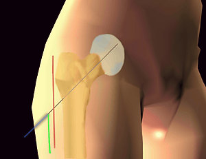 Mise en place d'une vis-plaque par mini abord externe
