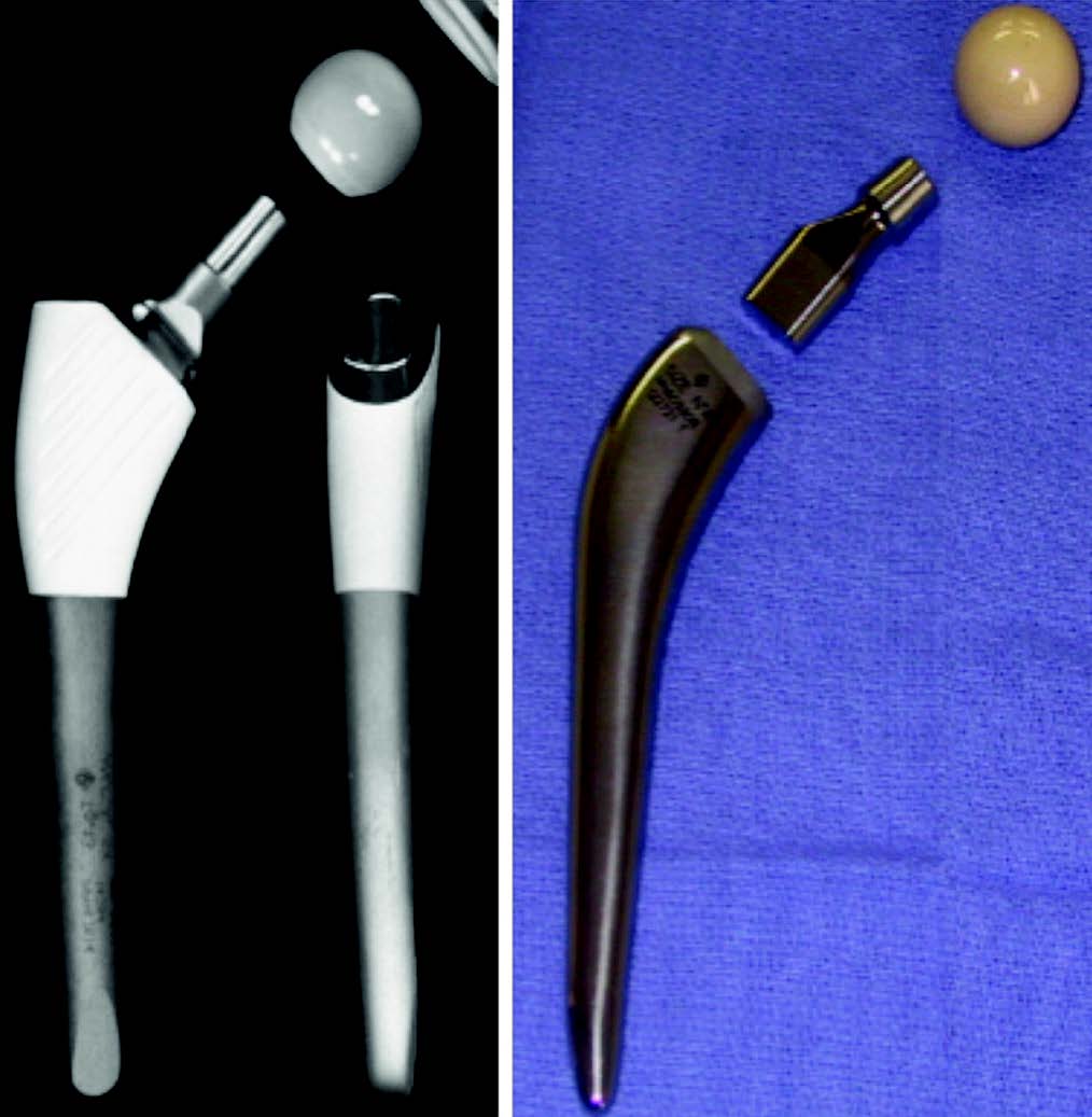 Les prothèses fémorales à col modulaire : Historique, évolution et expérience Amiénoise