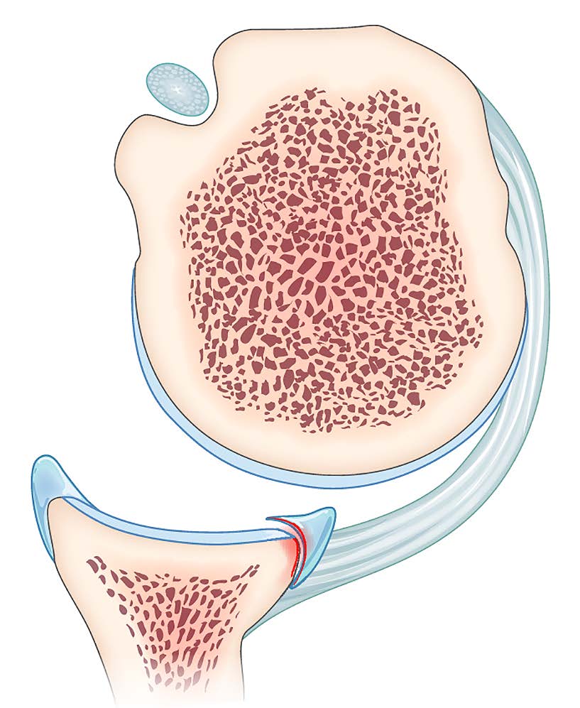 Traitement arthroscopique de l’instabilité postérieure de l’épaule