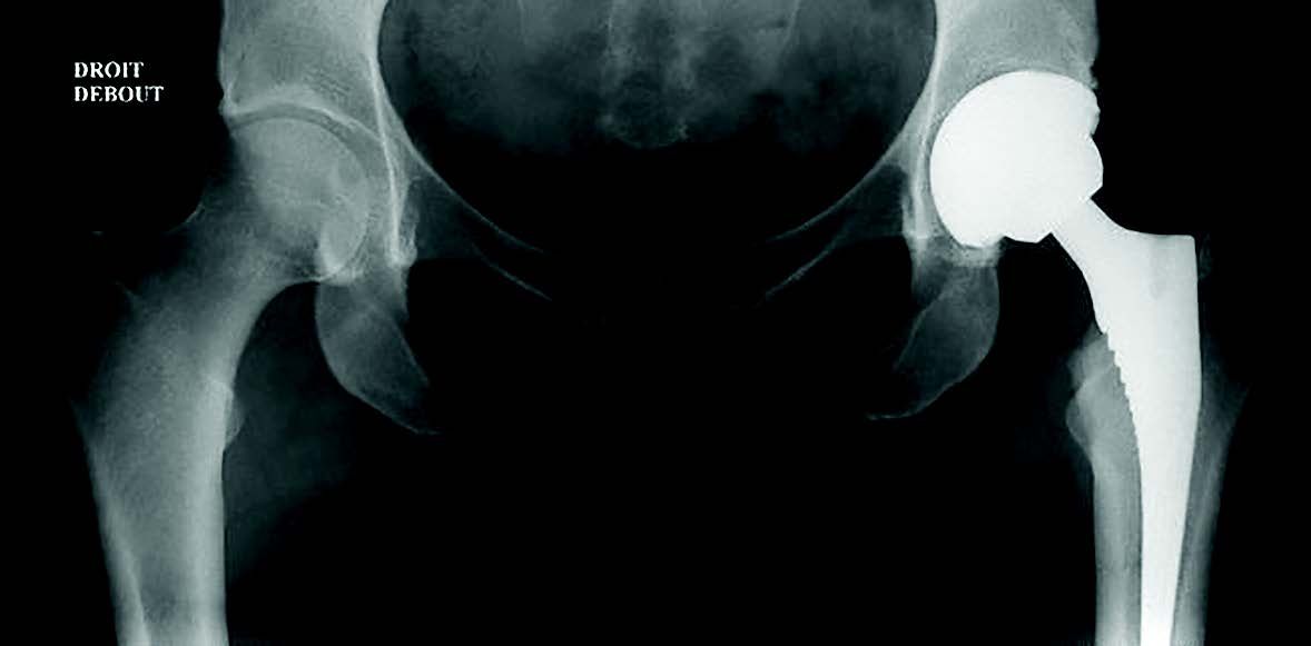 Extraction proximale d’une tige sans ciment à revêtement hydroxyapatite total : guide technique