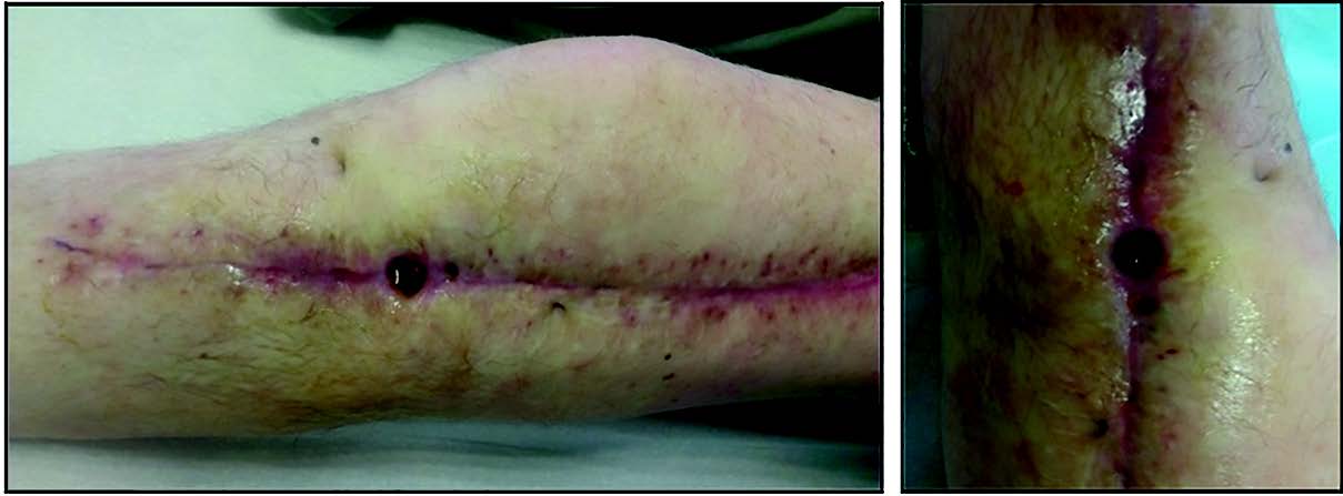 Prise en charge des Sepsis sur Prothèse Totale de Genou