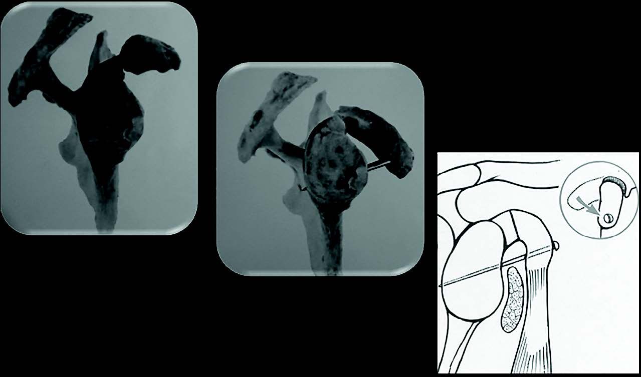 Mise au point d’une technique originale de « Trillat Arthroscopique » dans le traitement de l’instabilité antérieure chronique d’épaule