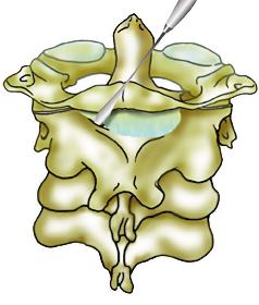 Technique du vissage des pédicules de C2