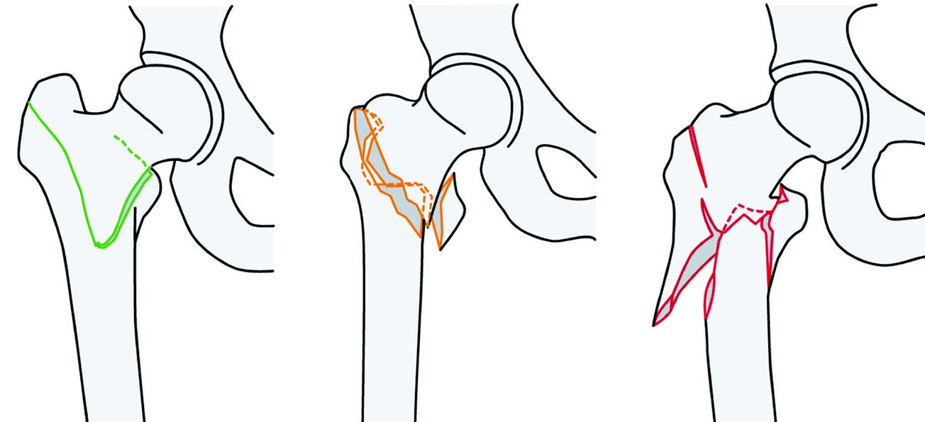 Cimenter l’implant cervico-céphalique dans l’enclouage des fractures du massif trochantérien : Comment ? Pourquoi ? Pour qui ?