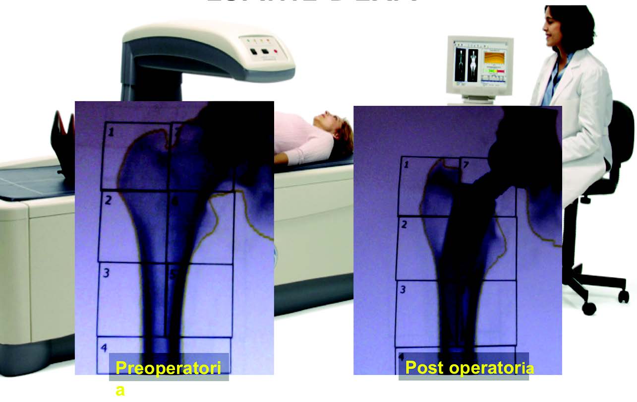 Etude comparative DEXA de 2 types de tiges fémorales à conservation de stock osseux