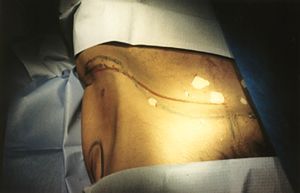 Fracture du cotyle et voie d'abord ilio-inguinale