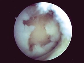 Les greffes osteo-chondrales selon la technique de la mosaicplasty