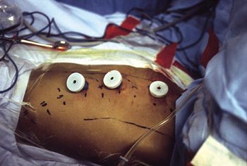 Chirurgie Endoscopique du Rachis : premier bilan après 4 ans de pratique.