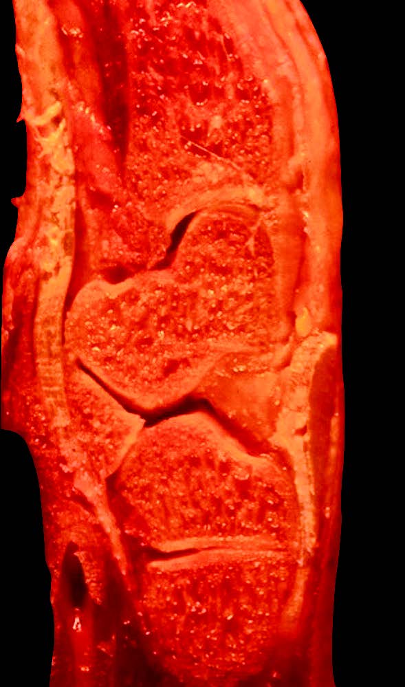 Anatomie et biomécanique des ligaments du carpe - Application à la classification des Instabilités