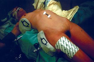 Mini abord et chirurgie percutanée : l'abord antérieur rétropéritonéal minimisé du rachis de T12 à S1