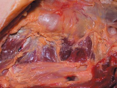 Diminution du risque hémorragique lors de la réalisation d'une arthroplastie par voie postérieure par ligature du pédicule circonflexe médial de la cuisse