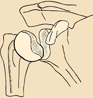 Classification des fractures articulaires de l'extrémité supérieure de l'humérus