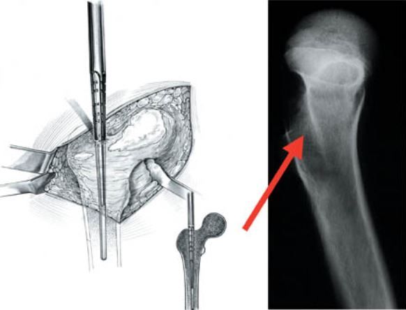 Les conditions de la bonne cimentation pour les PTH